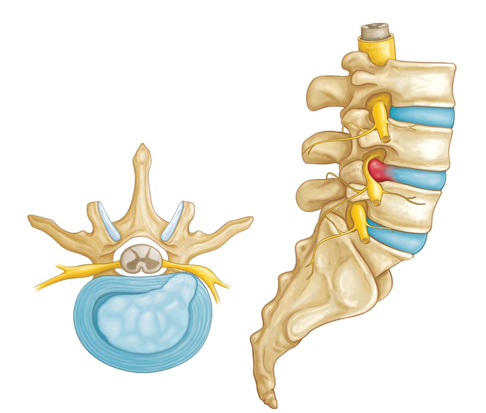 disk herniation model in Dallas